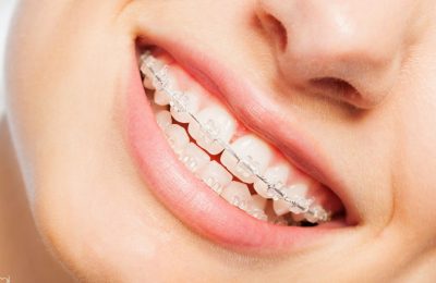 Understanding Retention: How Post-Braces Care Maintains Your Orthodontic Success