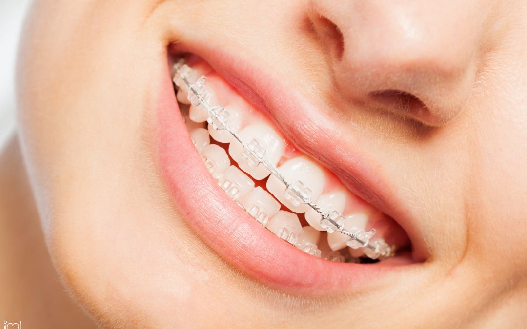Understanding Retention: How Post-Braces Care Maintains Your Orthodontic Success